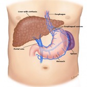 Лигирование вен пищевода. Лечение портальной гипертензии