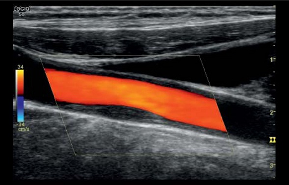 УЗИ сосудов верхних и нижних конечностей с режимом B-flow