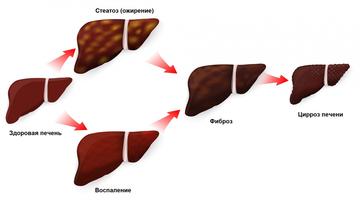 Стадии патологических изменений печени