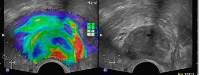 УЗИ с эластографией предстательной железы