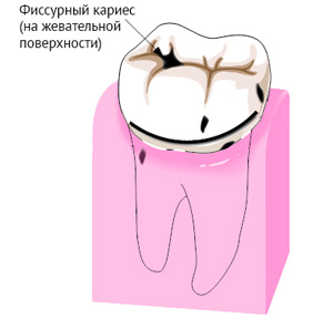 Лечение фиссурного кариеса (на жевательной поверхности)