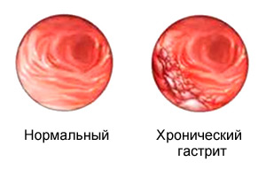 Хронический гастрит