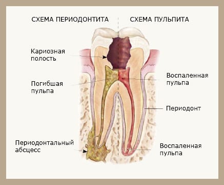 Пульпит при отсутствии лечения перетекает в периодонтит