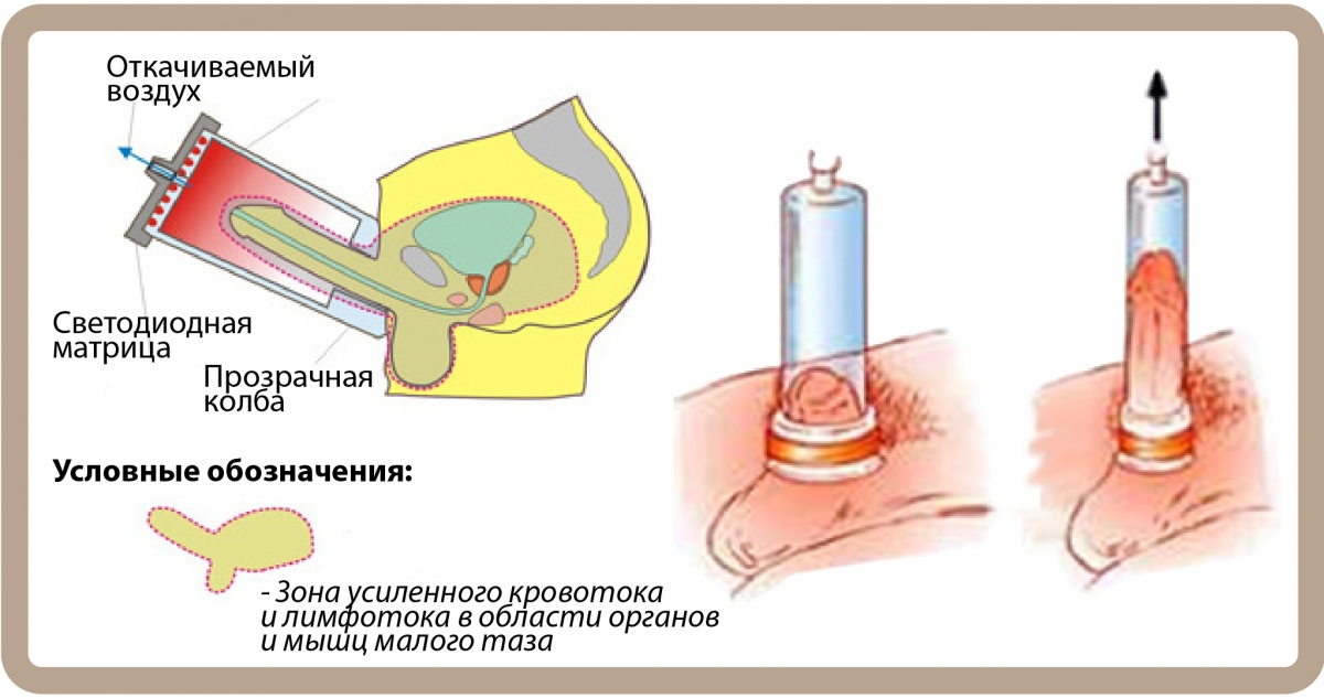 Принцип действия ЛОД-терапии