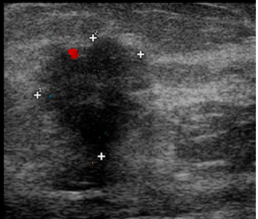 Пример УЗИ молочной железы - рак