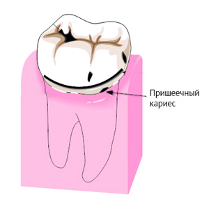 Лечение пришеечного кариеса