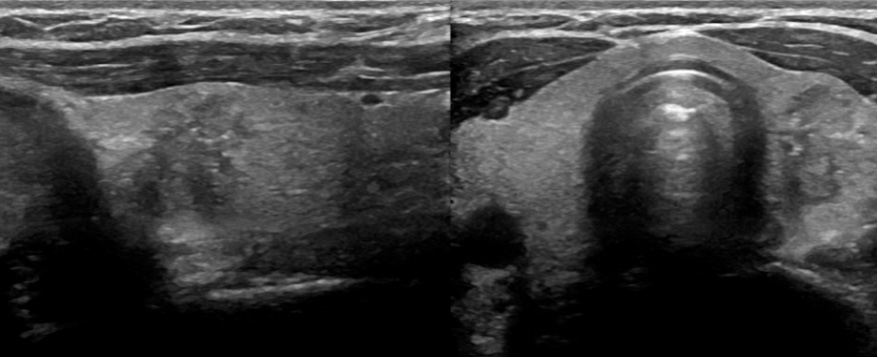 Пример УЗИ щитовидной железы - новообразование с неровными контурами